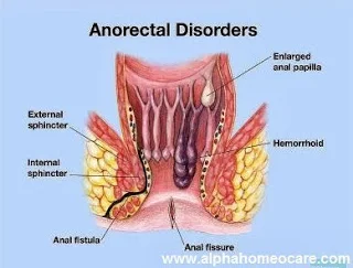 এনাল ফিসার, ফিস্টুলা, পাইলস এবং হোমিওপ্যাথি।