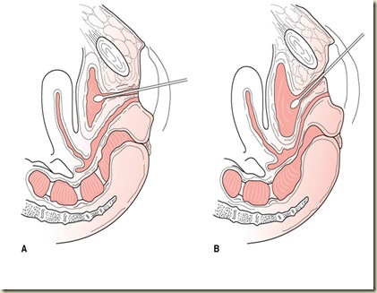 Cotton Bud Test