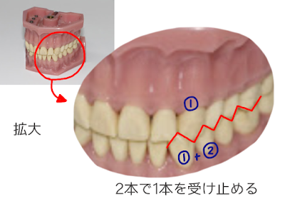 歯科矯正の画像　©さんがつの歯科矯正を始めます