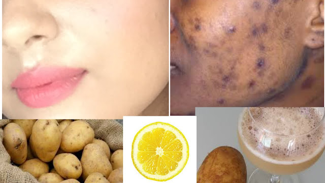 como remover melasma do rosto naturalmente