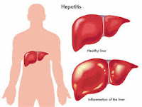 penyakit hepatitis b