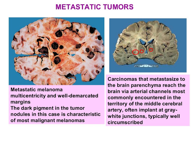 matastatic tumors