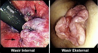 Berapa Harga Obat Wasir Ambejoss Di Belu Atambua