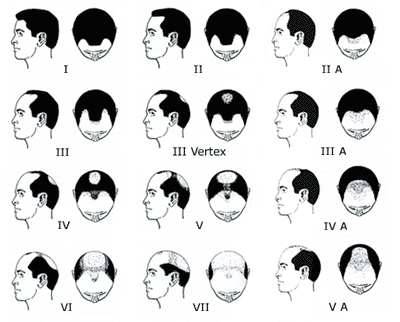 Mirena Coil And Hair Loss : Unravelling The Dhea Hypertension Connection