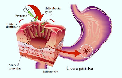 Úlceras - Causas, sintomas e Tratamento