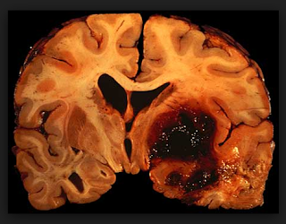 Cryptogenic Stroke Symptoms, Causes, Recurrence rates, Treatment