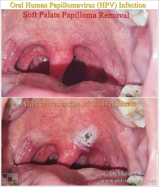 wart in the mouth,how to treat oral HPV?,papilloma in the mouth,HPV virus infection in the mouth,risk factors for oral HPV,oral HPV infection,oral HPV symptoms,