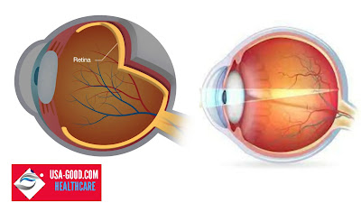 What is Retina