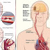 Ramuan Obat Penyakit Stroke