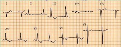 Elektrokardiogram EKG Pulmonary heart disease Kor pulmonal Cor Pulmonale