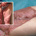 Wanita ini hampir kehilangan kaki yang dijangkiti bakteria pemakan daging selepas mencukur bulu kemaluan