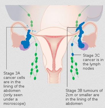 Stage 3A to 3C ovarian cancer