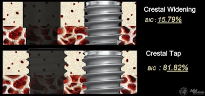 許永九博士的上顎竇人工植牙微創手術指引:CMI固定及植牙固定的種類