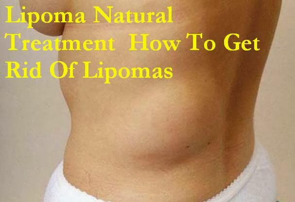 Lipoma Natural Treatment - How To Get Rid Of Lipomas | MedReeh