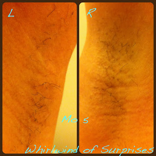 Tria laser treatment results