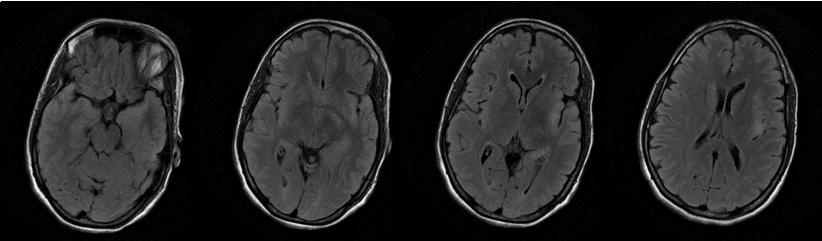 Dr Balaji Anvekar FRCR: Herpes Encephalitis MRI
