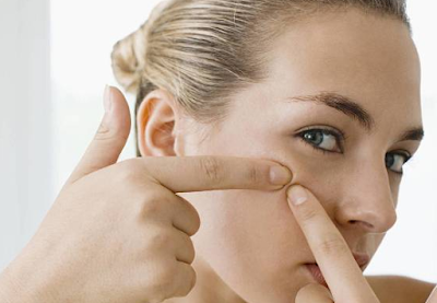 6 How to remove Stubborn Acne