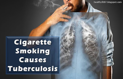 Smoking and Tuberculosis