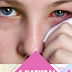 5 Natural Remedies for Pink Eye