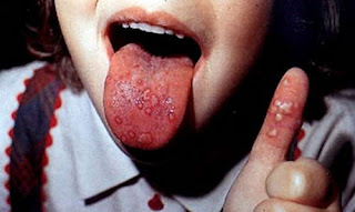  Severe lesions in the patient's mouth pictures