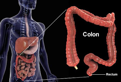 Sintomas De Cancer De Colon.