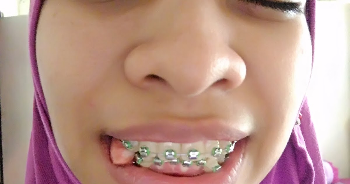 Pengalaman Mencabut Gigi Untuk Prosedur Braces  fatimahnabila