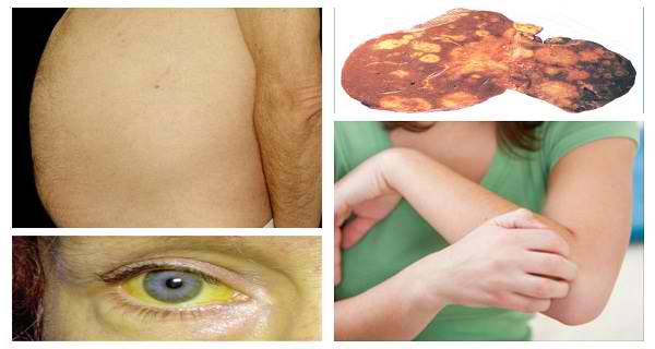 Symptoms of Liver Cancer You Should Never Ignore and What You Can Do to Reduce Your Risk 