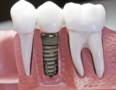 Cắm implant răng cửa có ưu điểm gì?