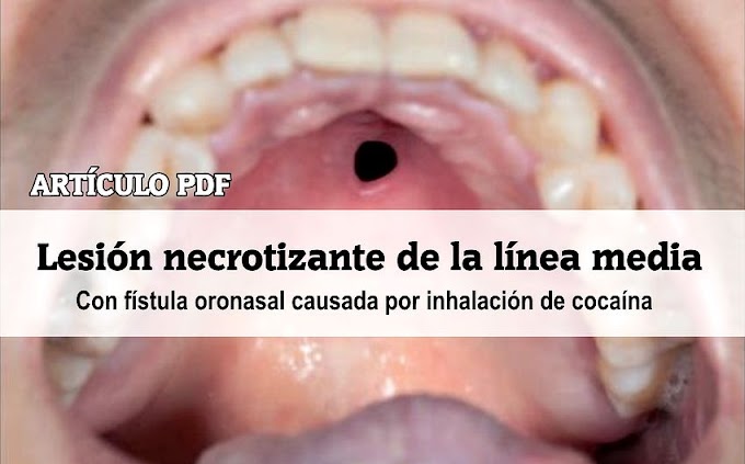 PDF: Lesión necrotizante de la línea media con fístula oronasal causada por inhalación de cocaína