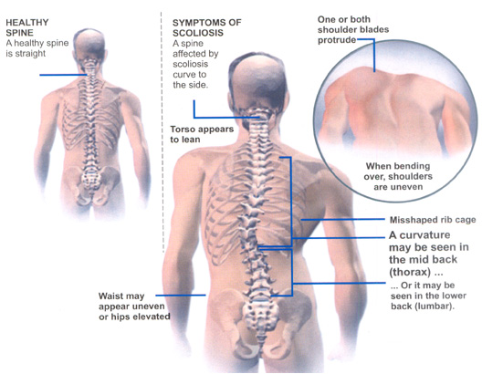 scoliosis  pain