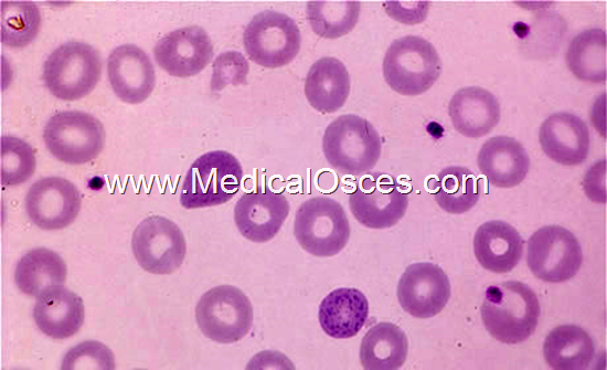 Hematology