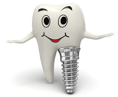 Mẹo giảm đau sau khi cấy ghép implant