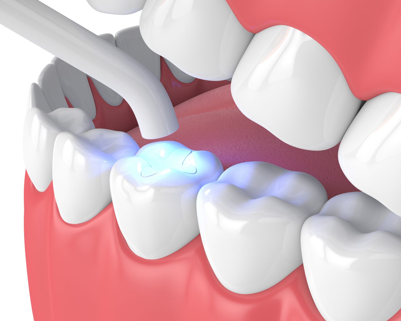 Composite Teeth Filling in Jamnagar ~ Dr. Bharat Katarmal Dental & Implant Clinic Composite Teeth Filling in Jamnagar ~ Dr. Bharat Katarmal Dental & Implant Clinic