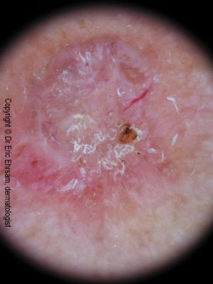 basal cell carcinoma,skin