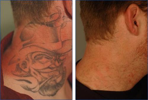 Remoção de Tatuagem a Laser Antes e Depois Tattoo Clinic