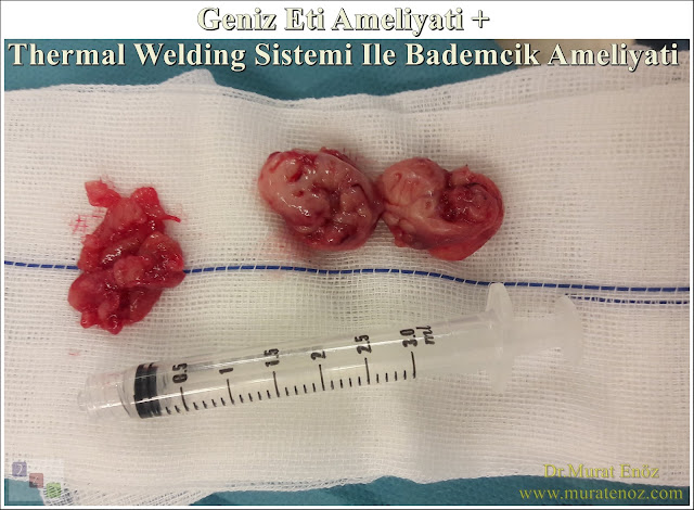 Geniz eti ameliyatı - Adenoidektomi - Thermal welding bademcik ameliyatı - Thermal welding yöntemi ile bademcik ameliyatı - Thermal welding tonsillektomi - Thermal welding kansız bademcik ameliyatı - Kansız bademcik ameliyatı