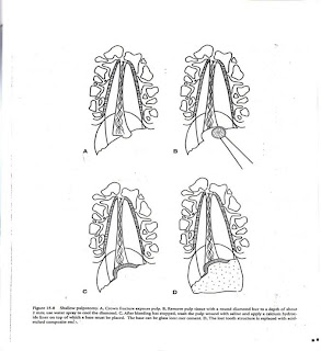 Trauma Endodontics