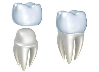Kỹ thuật bọc răng sứ toàn hàm mang lại nụ cười tự tin-1