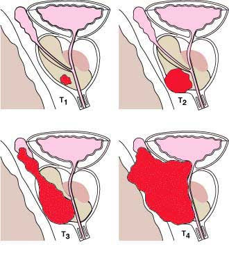 Images Prostate Cancer