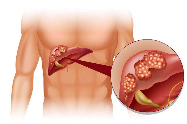 Gejala penyebab dan obat kanker hati