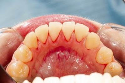 Nguyên nhân gây chảy máu răng là gì?