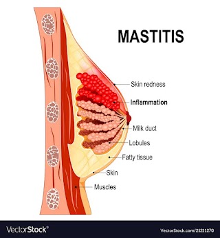 Mastitis