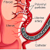 Uterine Artery Embolization, its procedure, Advantages, and Limitations