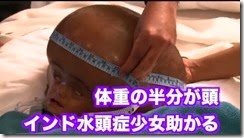 水頭症の印少女