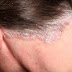 obat gatal pada rambut kepala aman tanpa efek samping