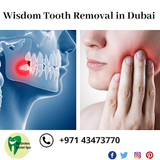 wisdom teeth removal in dubai