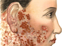 Penyebab, Gejala  dan Cara Mengobati Lupus