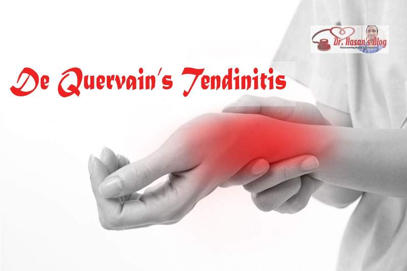 De Quervain’s Tendinitis (Tendinitis Quervain)