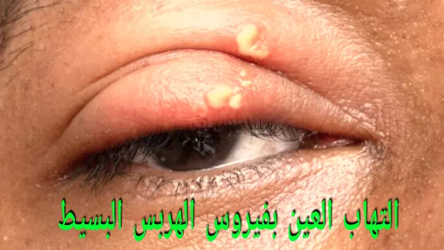 التهاب العين بفيروس الهربس البسيط التهاب العين بفيروس الهربس البسيط