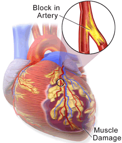 heart_disease